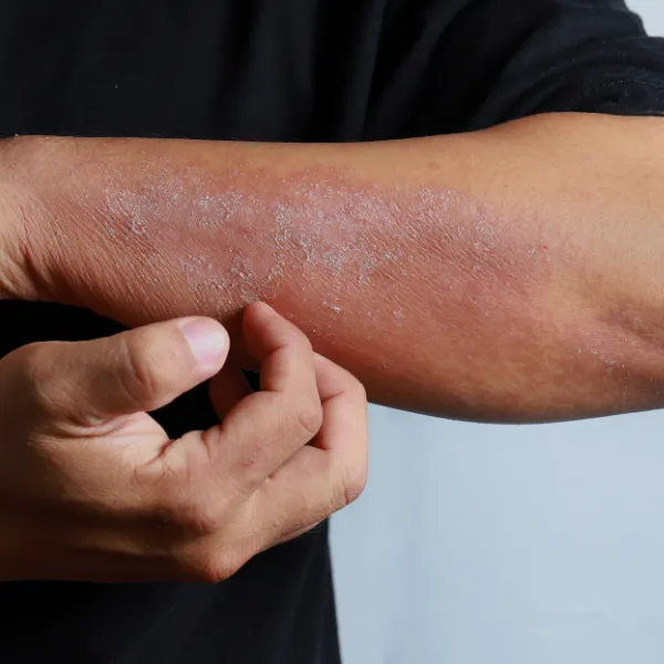 Close-up of eczema rash on arm — online dermatologist consultation available at DoxOnCall.ie