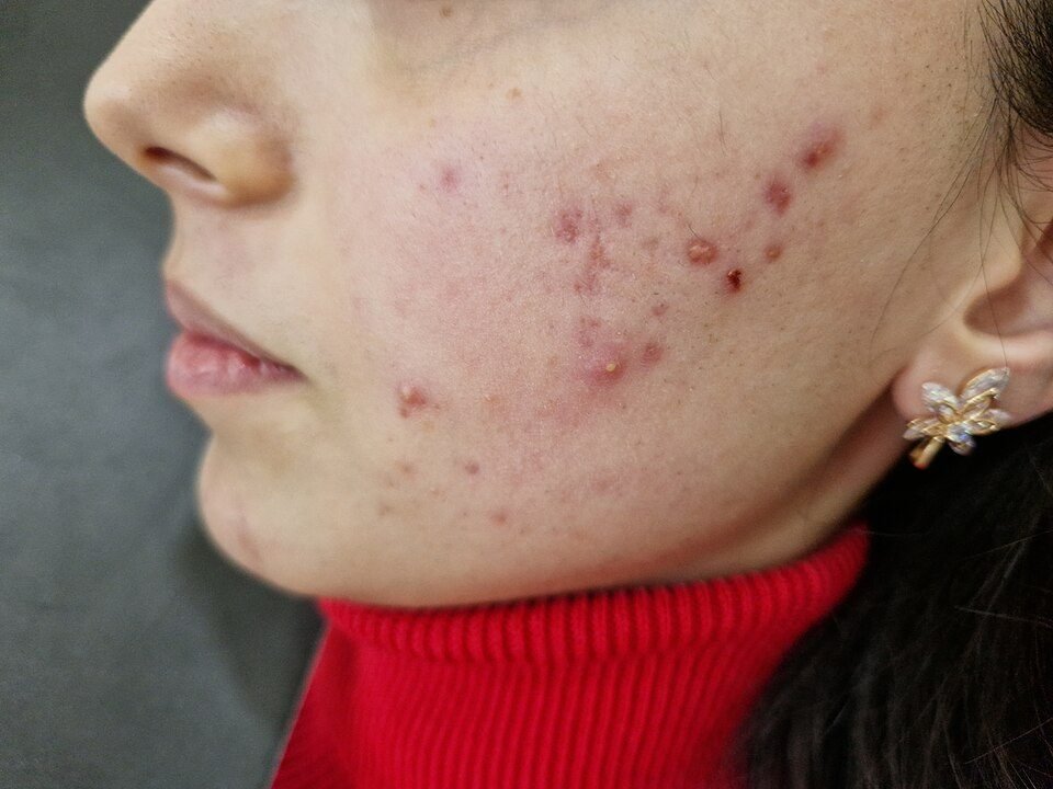 Inflammatory acne spots and deeper bumps on the cheek