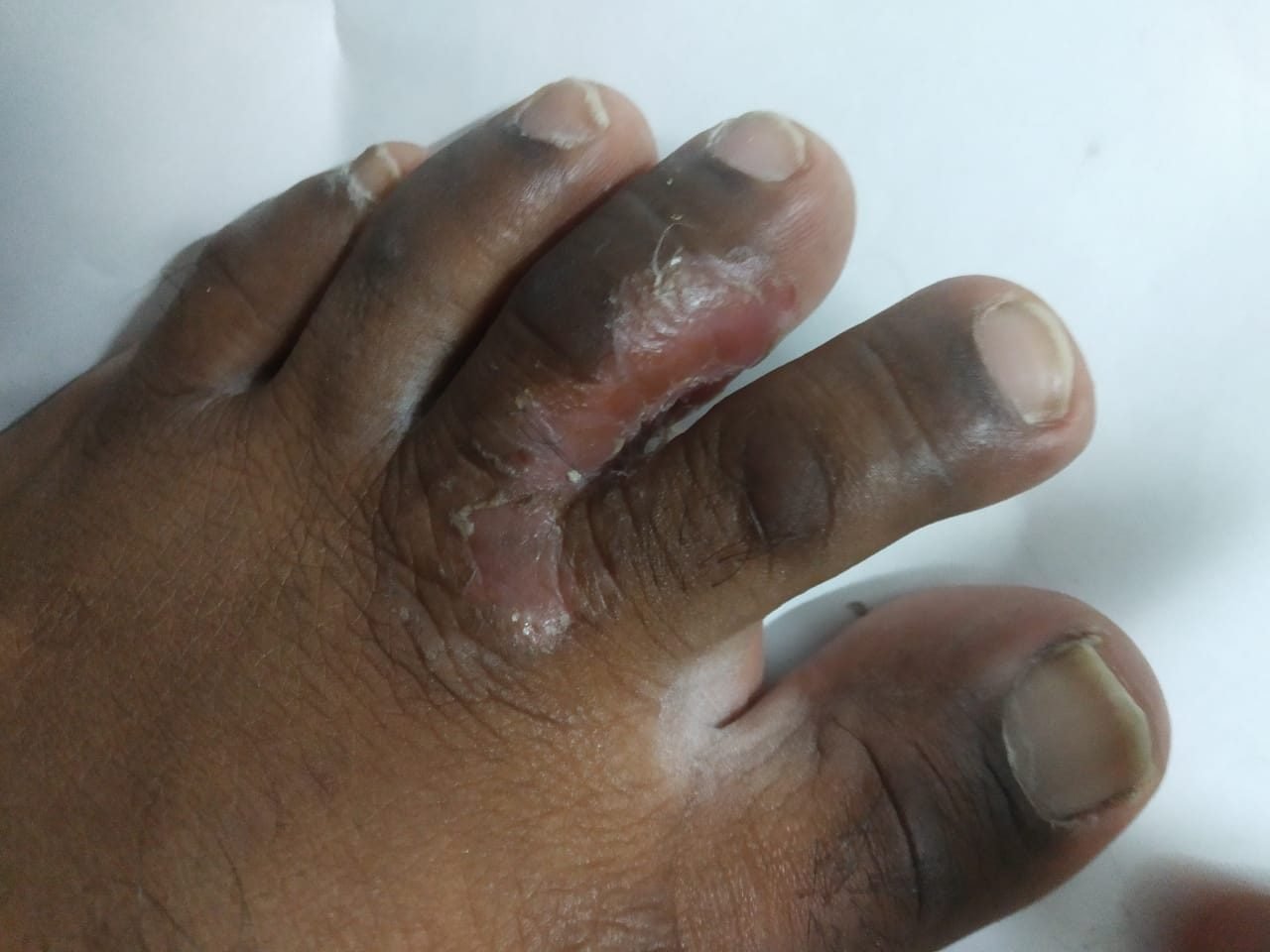 Peeling irritated skin in the toe web typical of athlete's foot