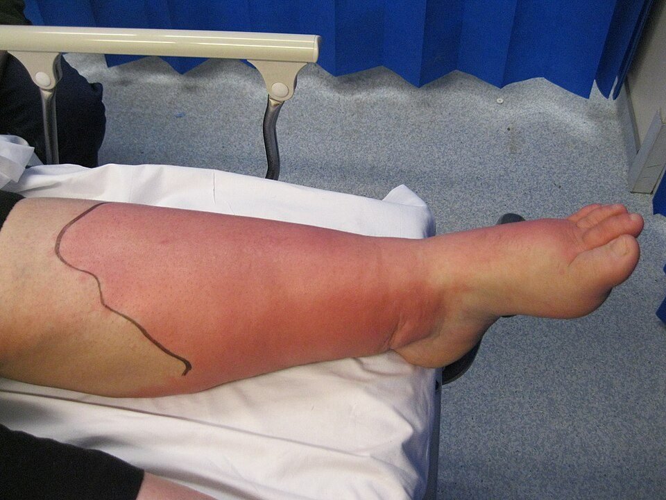 Spreading cellulitis redness on the lower leg marked in pen