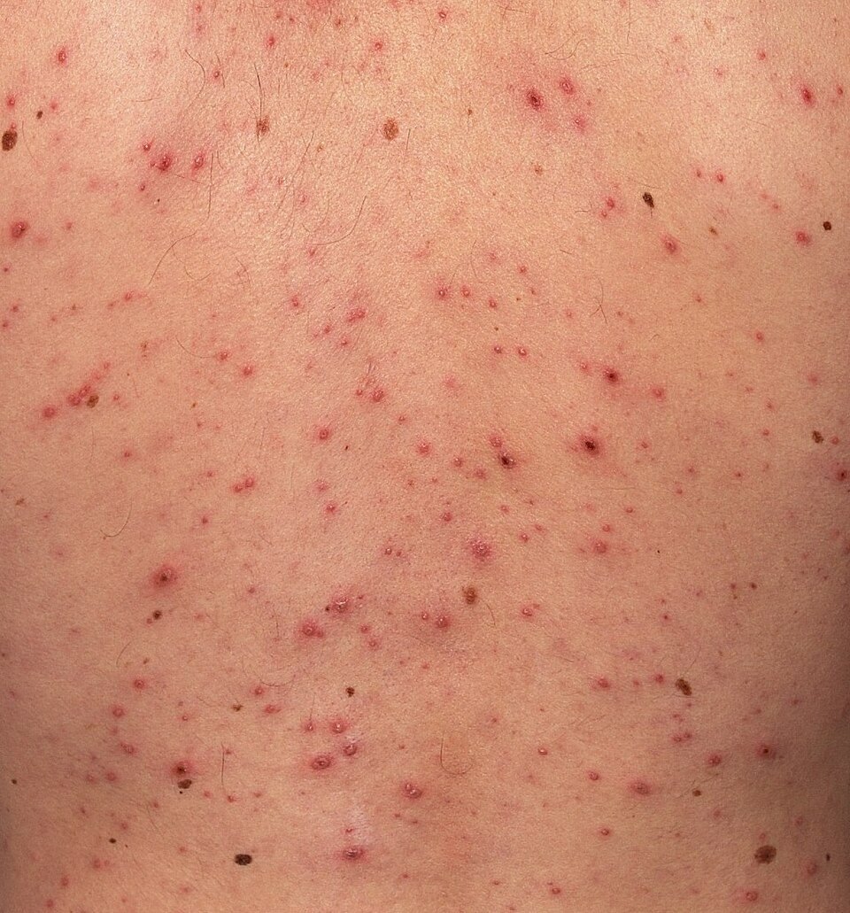 Chickenpox spots at mixed stages across an adult back