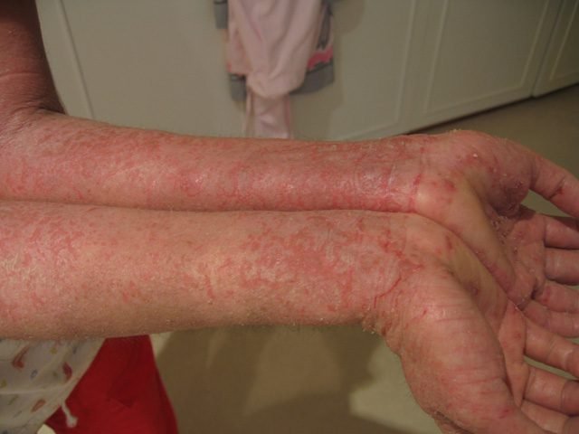 Eczema flare with red dry irritated skin on both arms