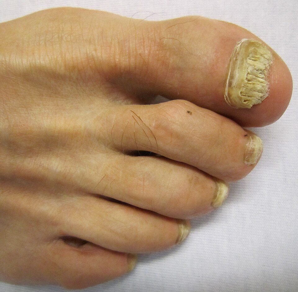 Thickened crumbly yellow toenail from a fungal infection