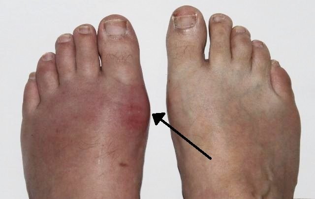 Gout flare with one red swollen big toe joint beside a normal foot