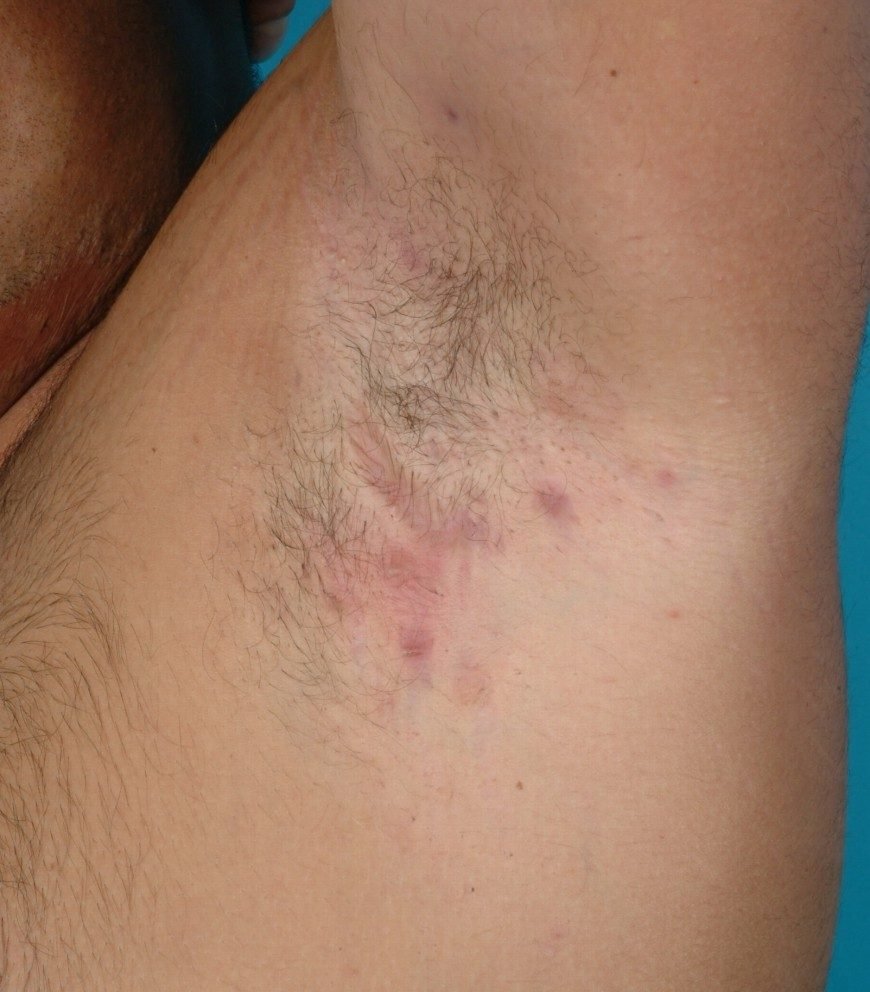 Recurring boil-like nodules of hidradenitis suppurativa in the armpit