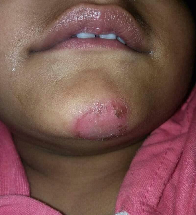 Honey-gold impetigo crusts around a child chin