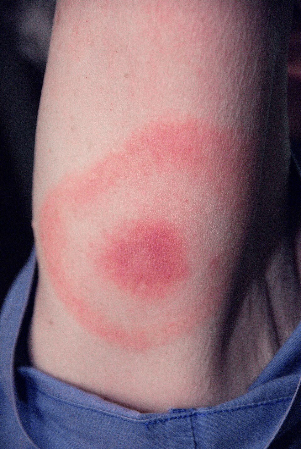 Slowly expanding bullseye ring of a Lyme disease rash