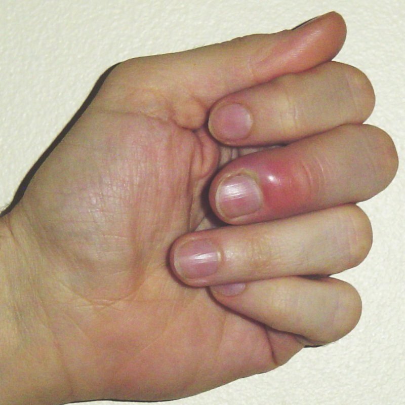 Red swollen nail fold of acute paronychia on a finger