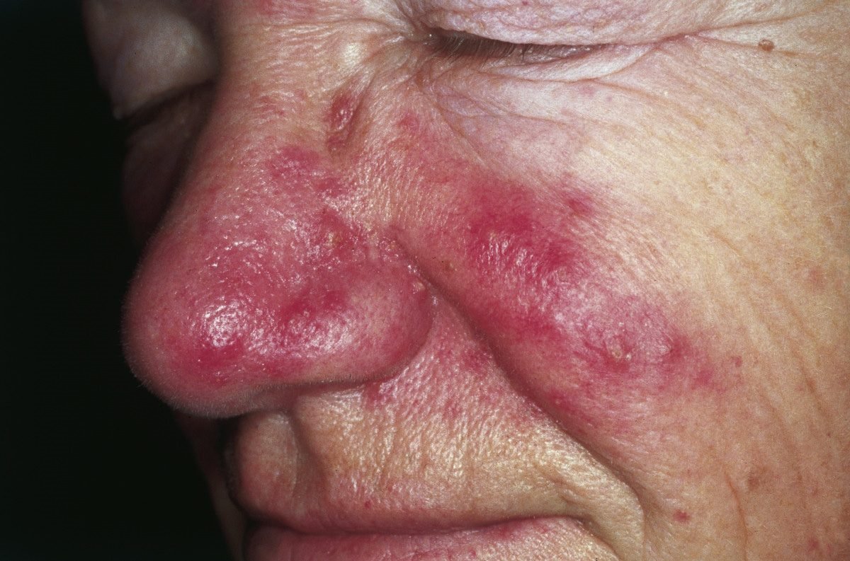 Fixed rosacea redness with small bumps over nose and cheeks