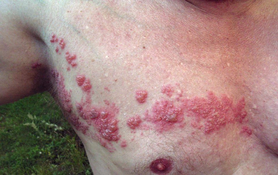 One-sided band of shingles blisters across the chest