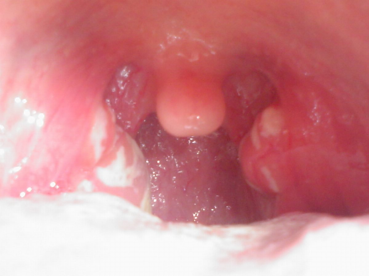 Very red tonsils with white patches suggesting strep throat